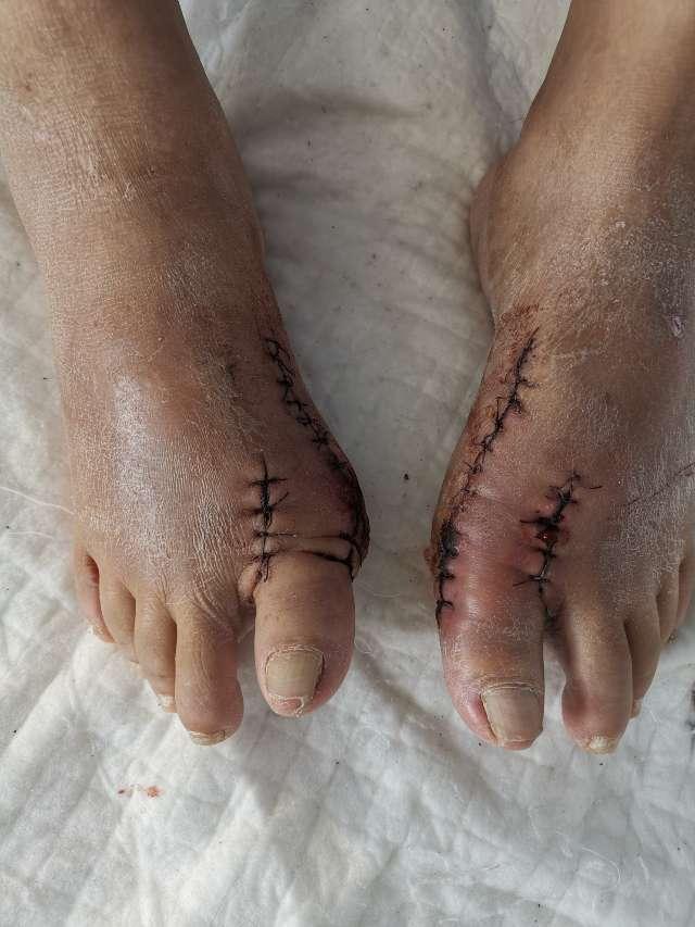 拇外翻大脚骨手术矫治术