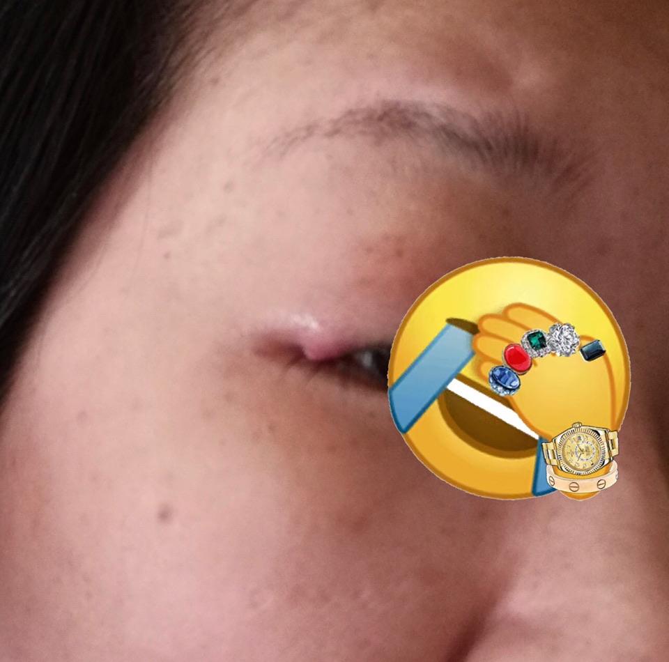 麦粒肿退不下去,怎么解决? - 微医(挂号网)