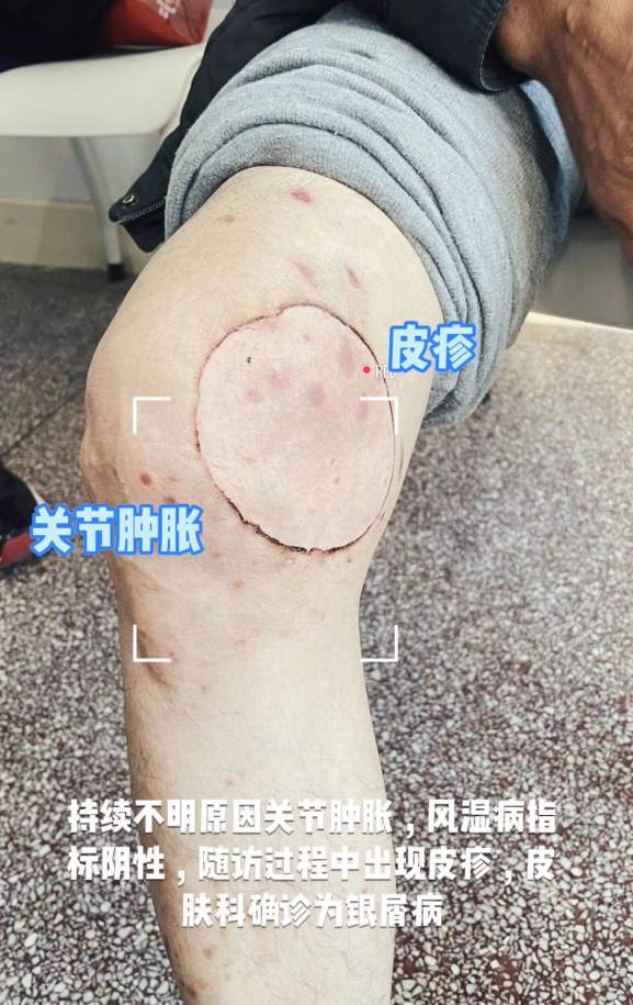 银屑病关节炎皮肤病也会引起关节炎