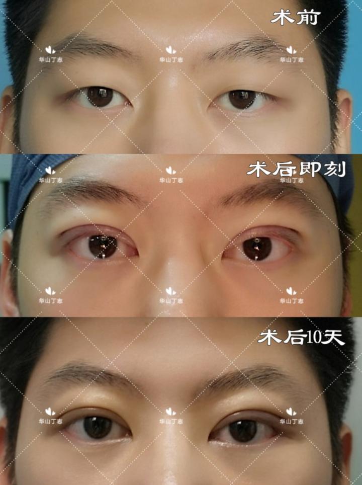 全切双眼皮前后第10天