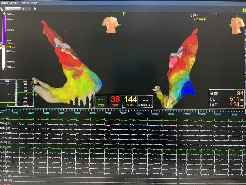 左心室室早,穿刺股动脉,标测消融电极逆行到达左心,标测消融.
