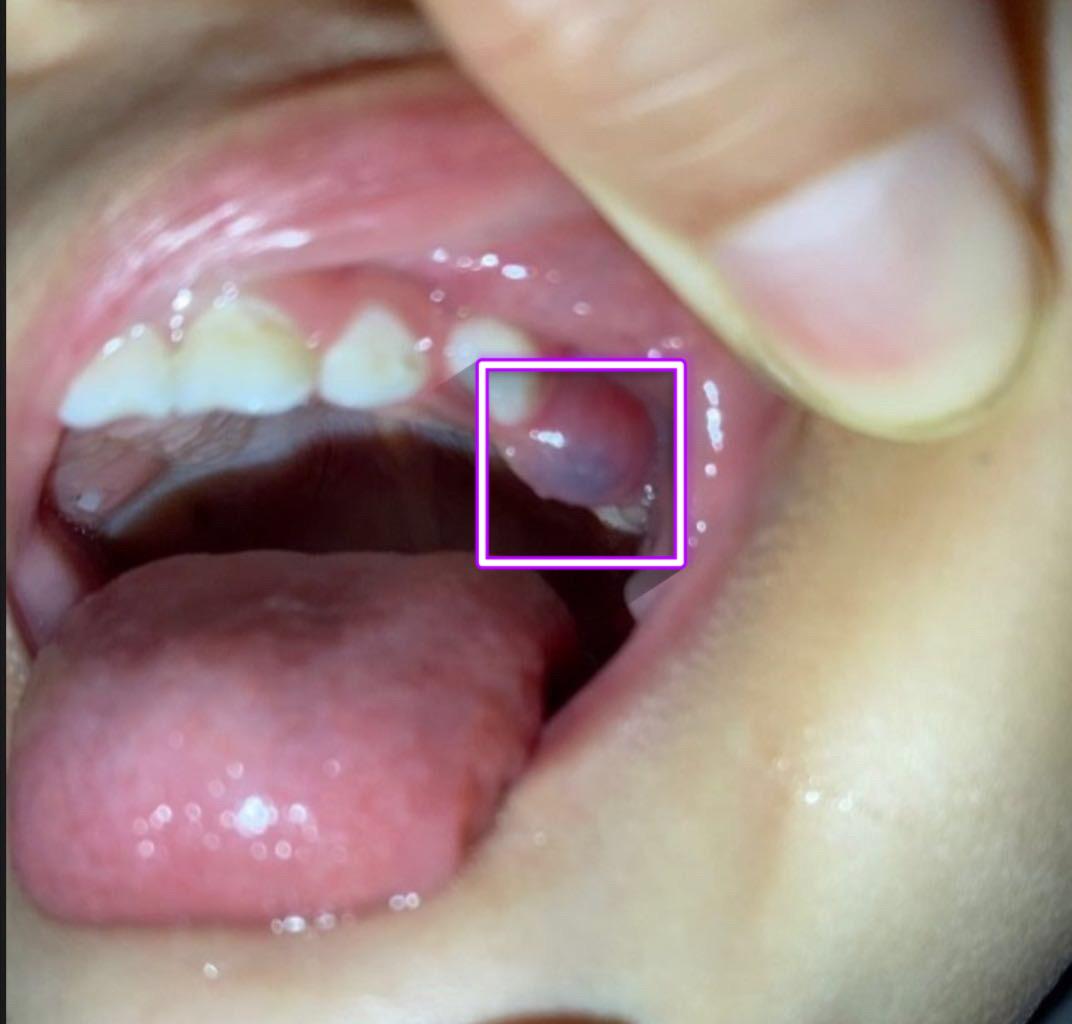 乳牙在萌出时可见覆盖在牙齿上的粘膜呈现青紫色,内含组织液和血液,称