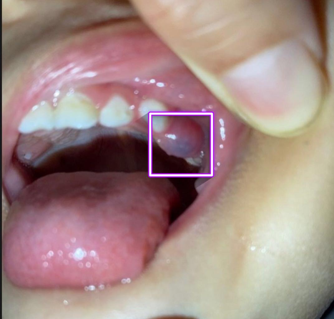 寶寶牙齦血泡