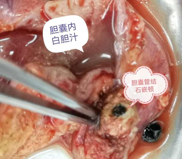 胆结石久病未治黄金胆汁竟然变成白色