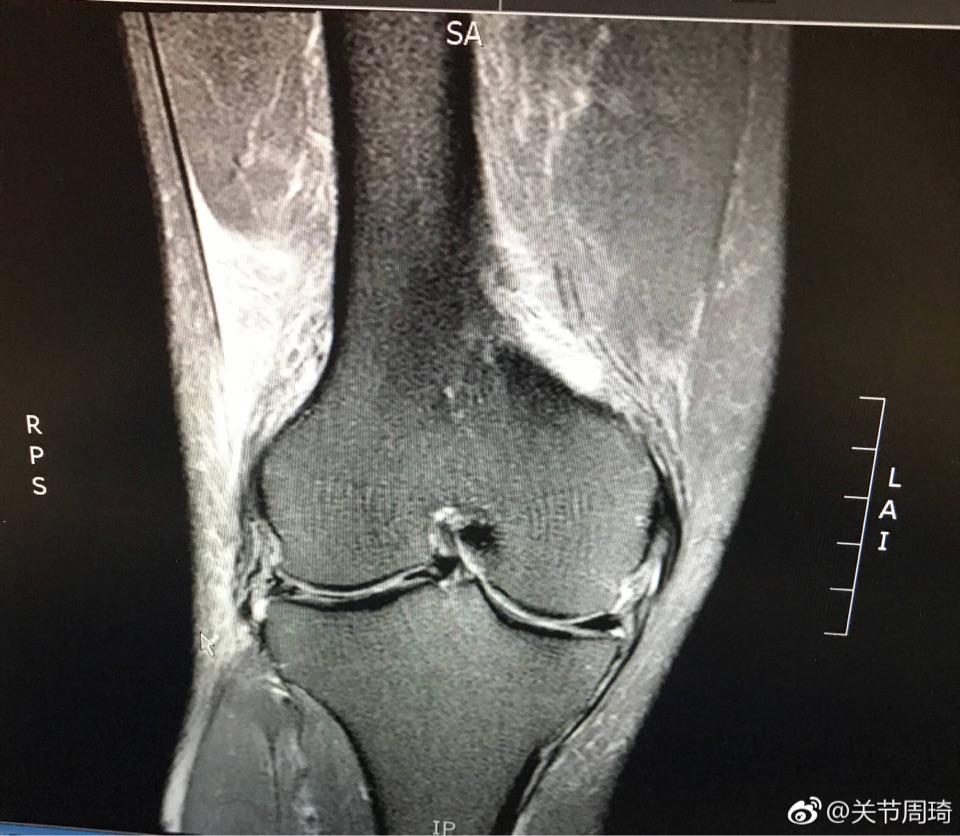 外側半月板桶柄樣撕裂行膝關節鏡下外側半月板縫合手術,留住了患者的