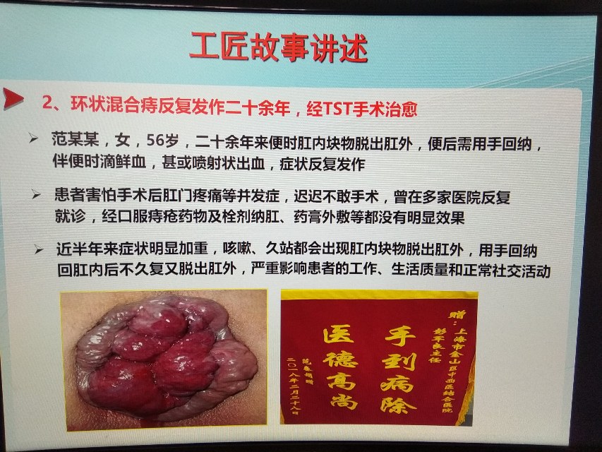 环状混合痔反复发作二十余年经我科采用tst手术治愈