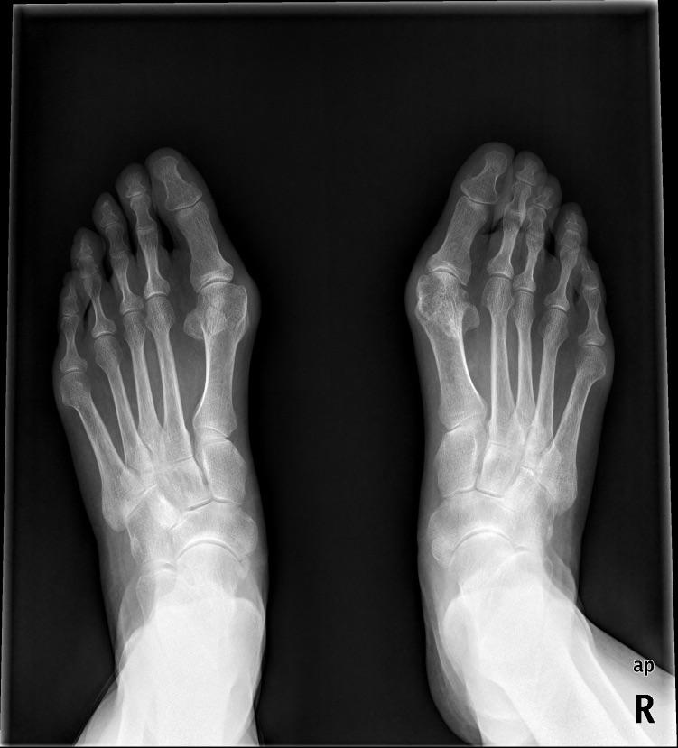 踇外翻——对女性造成困扰最大的足部畸形_刘津浩医生