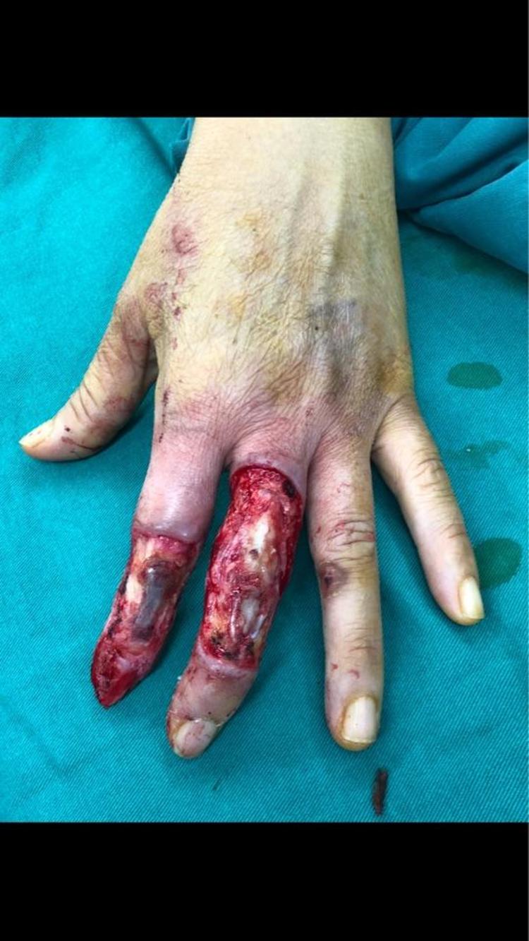 左手食中指热压伤皮瓣修复及分指术后