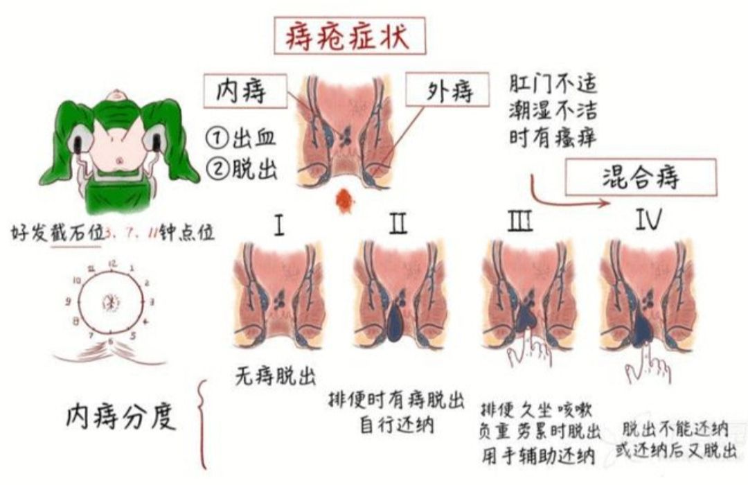 痔疮几期示意图图片