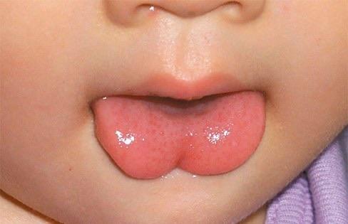 婴儿攀舌的症状图片图片