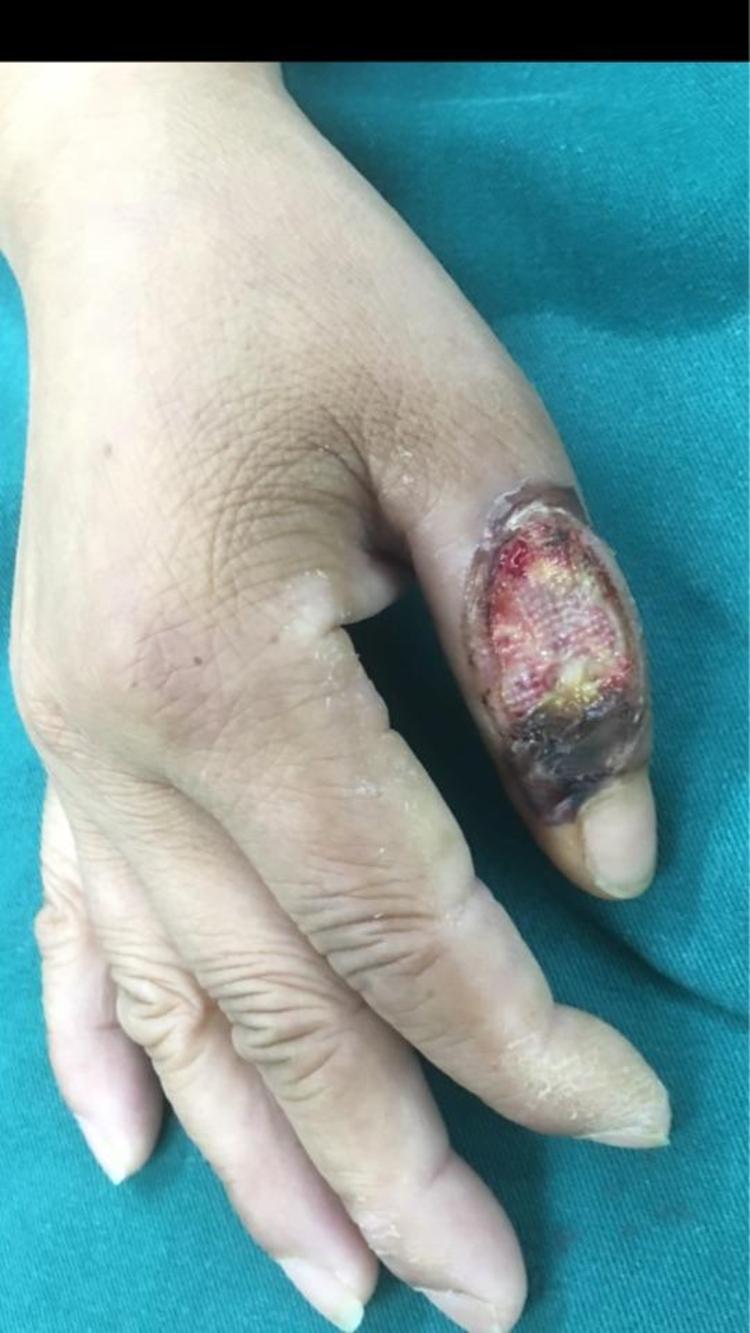 右手拇指热压伤 - 微医(挂号网)