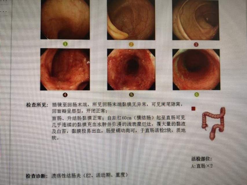 溃疡性结肠炎中药不比西药差啊