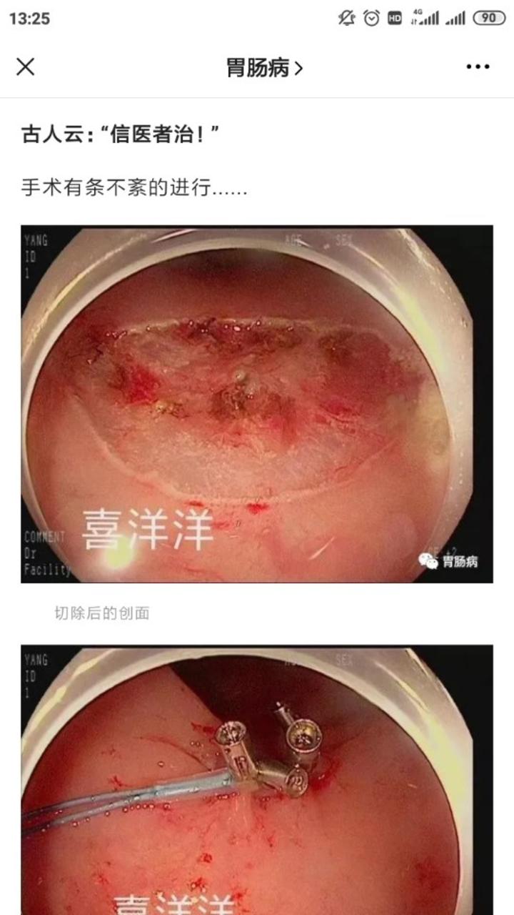 一次肠镜让我躲过了肠癌的魔爪