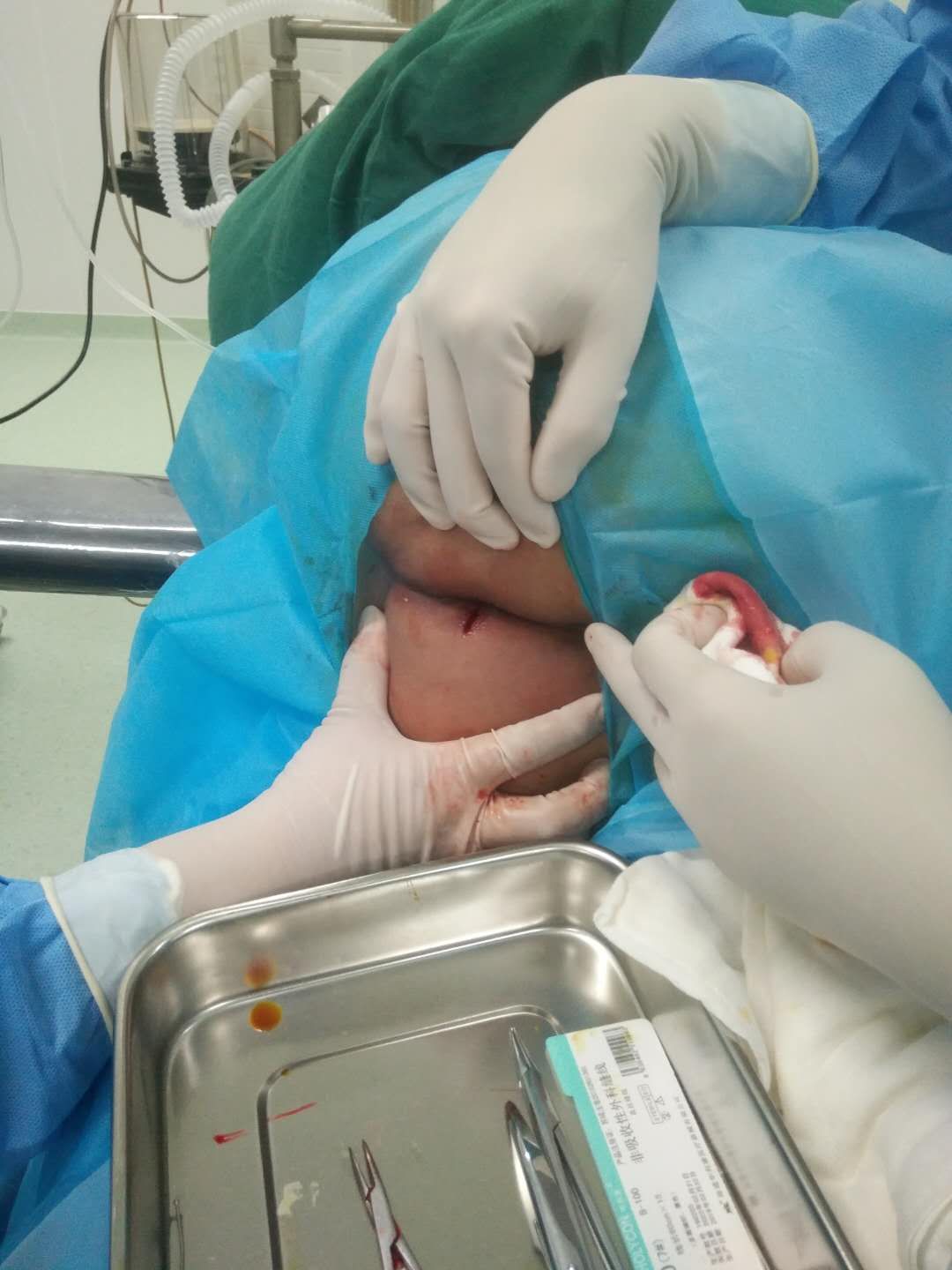 高位马蹄形肛周脓肿肛周脓肿应及时治疗否则会越来越严重