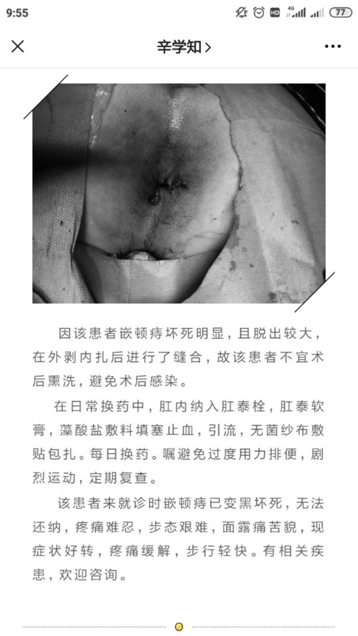 四期内痔处理嵌顿痔治疗方法介绍我院肛肠科开展改进pph即tst手术