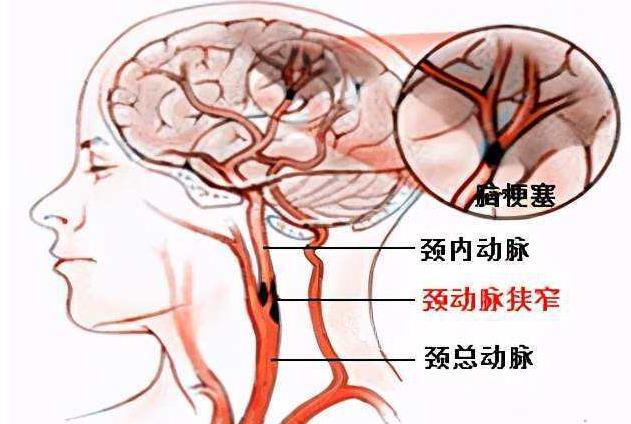 颈总动脉分支解剖图图片