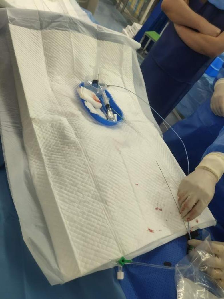 房颤冷冻消融术