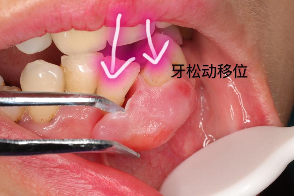 牙龈瘤,门诊手术微创摘除