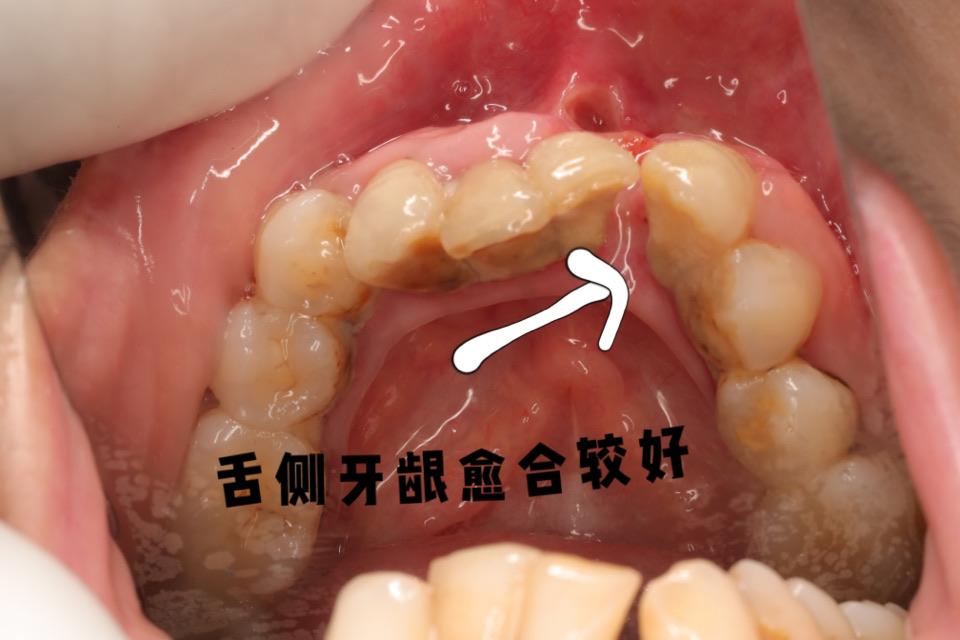 牙龈瘤门诊手术微创摘除
