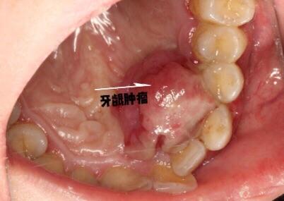 牙龈瘤微创摘除3例