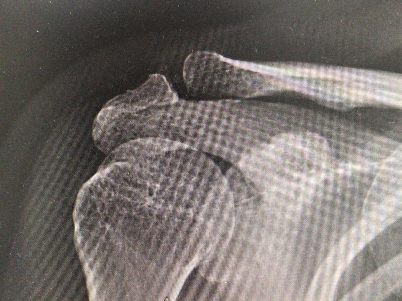 肩峰下撞击的痛别让肩周炎来背锅