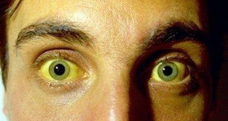 了解胆红素与黄疸