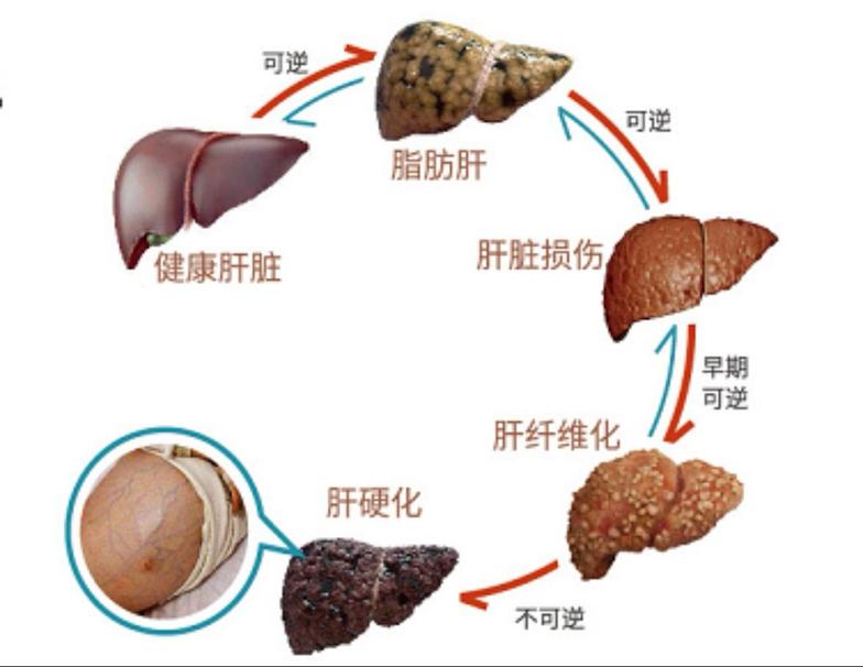 脂肪肝
