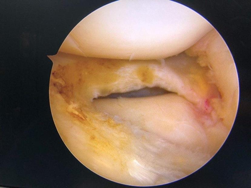 外侧盘状半月板成形
