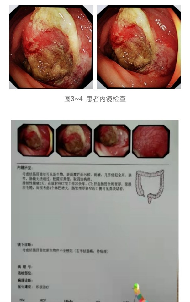 大肠癌肚子图片