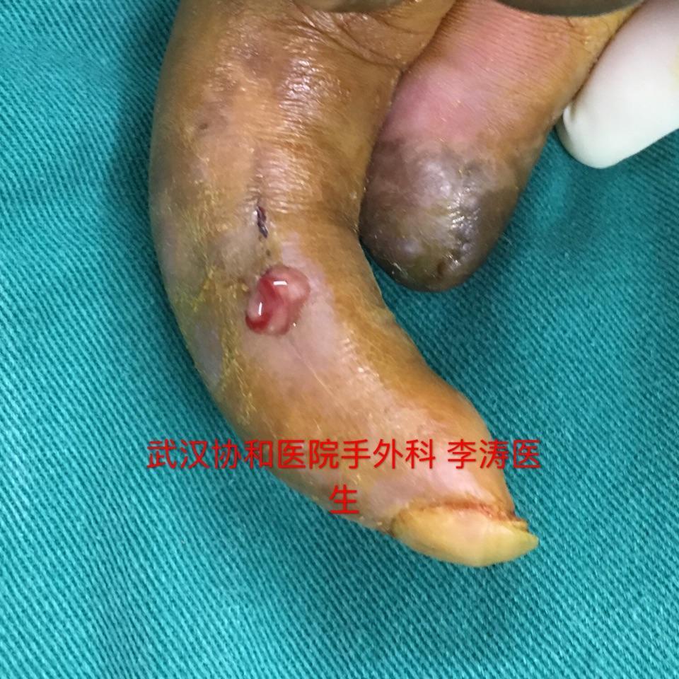 手指慢性骨髓炎感染的治疗困难及目前的方法