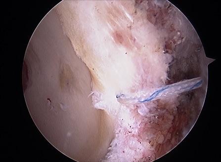 髋关节盂唇损伤髋关节镜治疗缓解