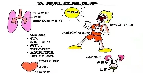 我是怎么得系统性红斑狼疮的