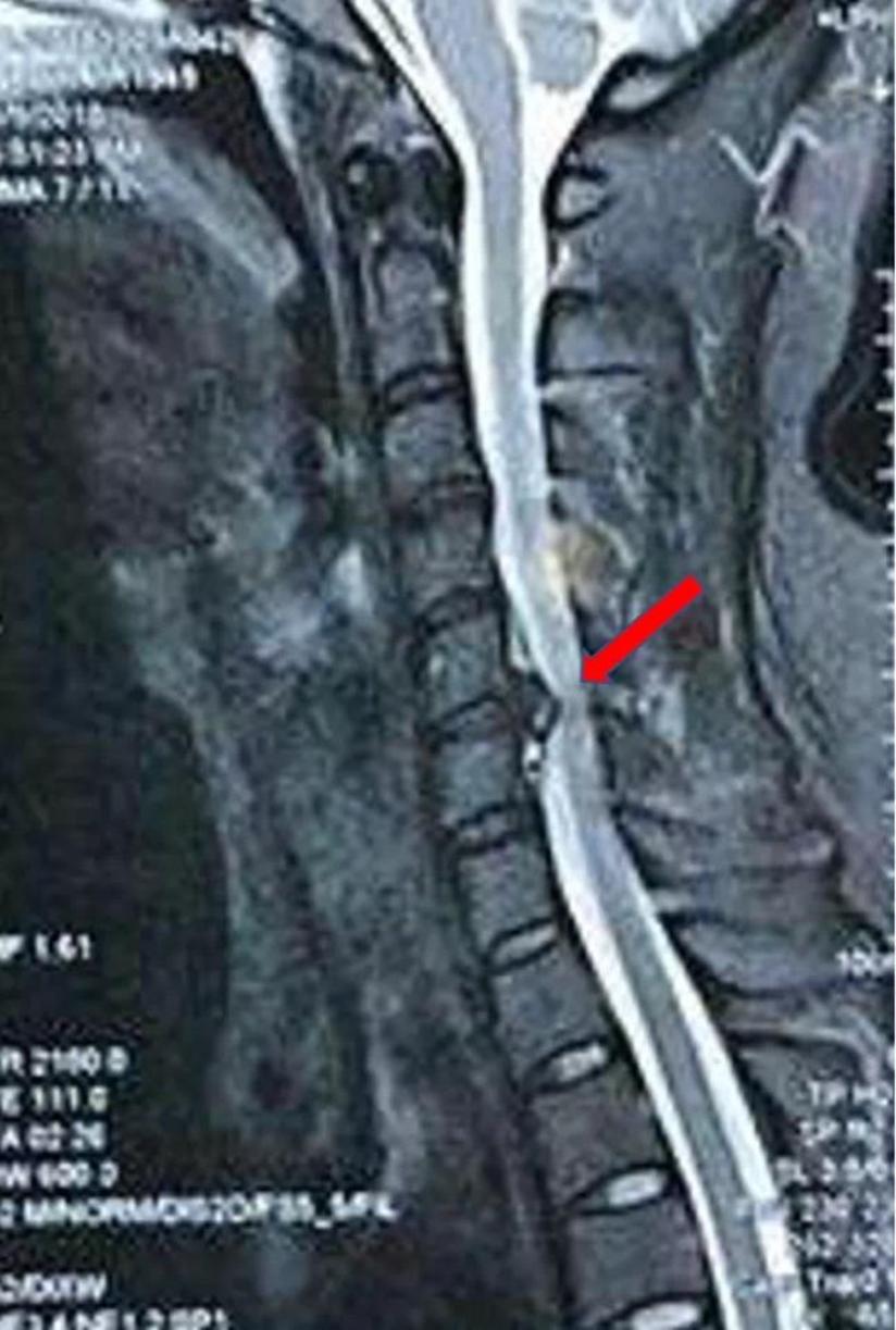 颈肩上肢疼痛麻木 神经根型颈椎病 健康号 微医