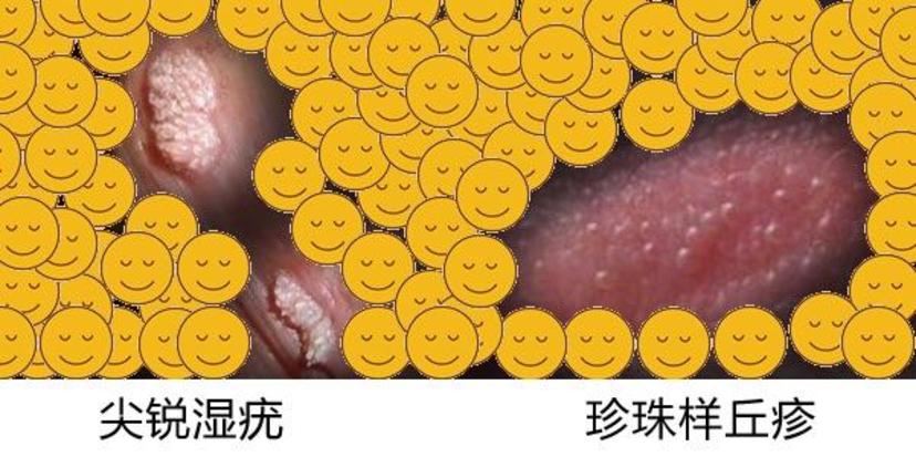 尖锐湿疣是一种什么疾病