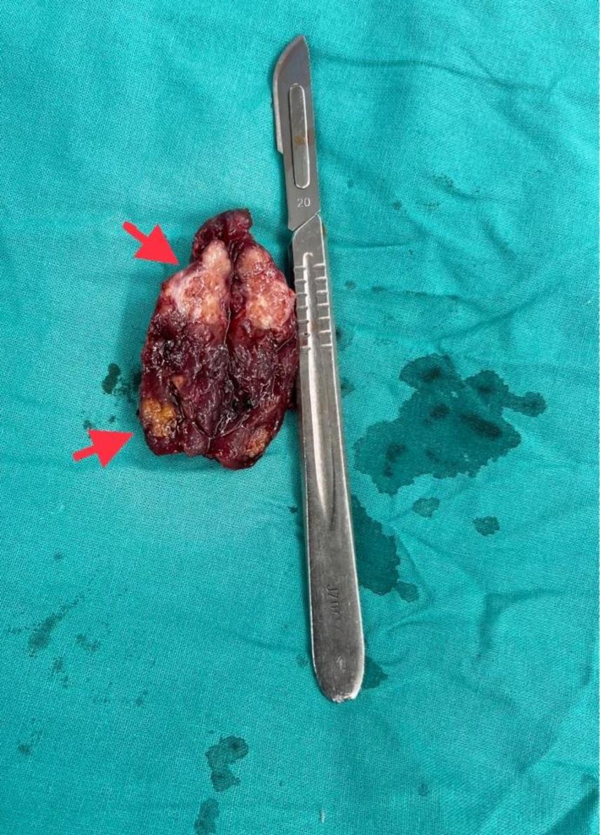 20岁女性甲状腺乳头癌广泛淋巴结转移