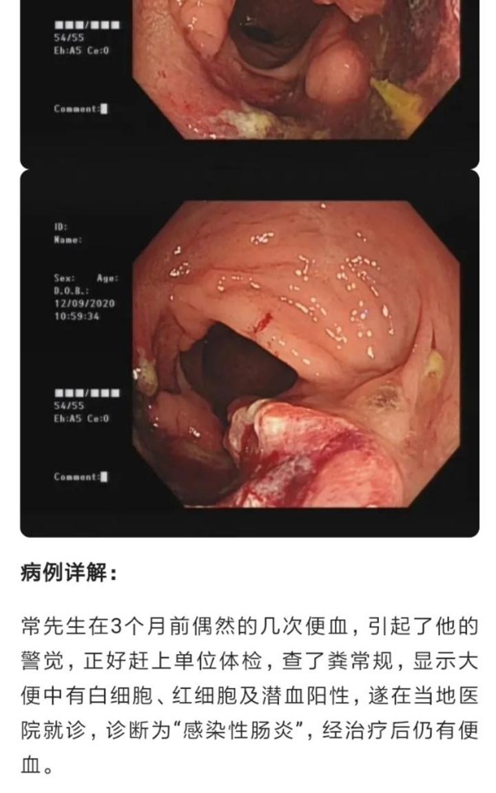 又一例被误诊为痔疮的直肠癌