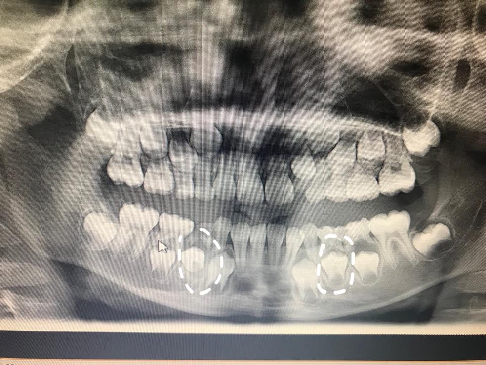 乳牙蛀牙不用补