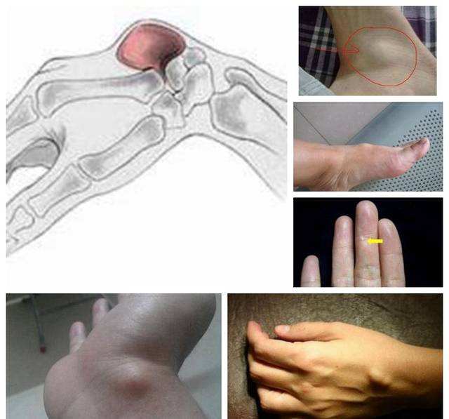 什么是腱鞘囊肿都需要手术治疗吗