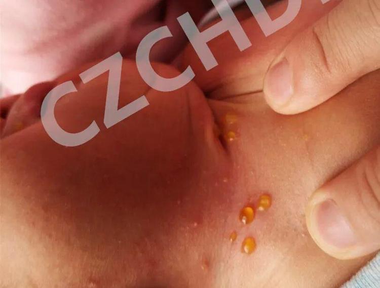 多见于幼童,通常认为是接触沙土等粗糙物体引起的非特异性皮肤反应