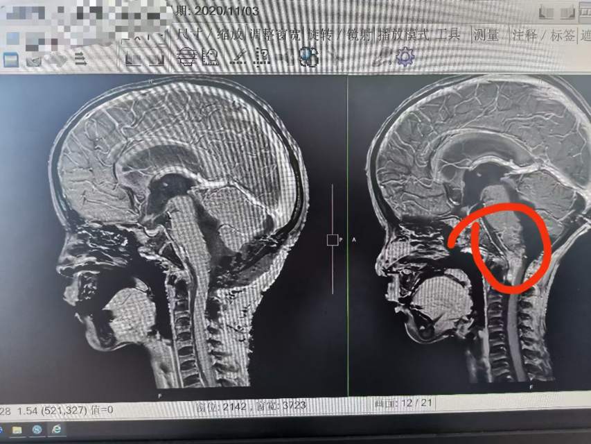 生长方式刁钻的后颅窝室管膜瘤