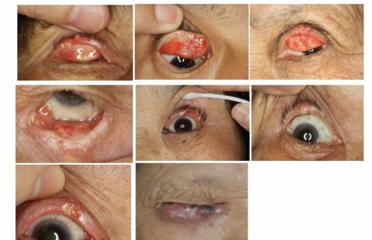 起源于眼睑的睑板腺(meibomian腺)和睫毛皮脂腺(zeis腺).