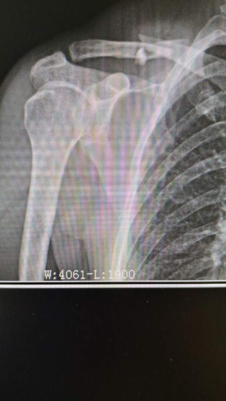 如果是锁骨骨折的中段或者是远端出现骨折,通常骨折的近端是由于胸锁