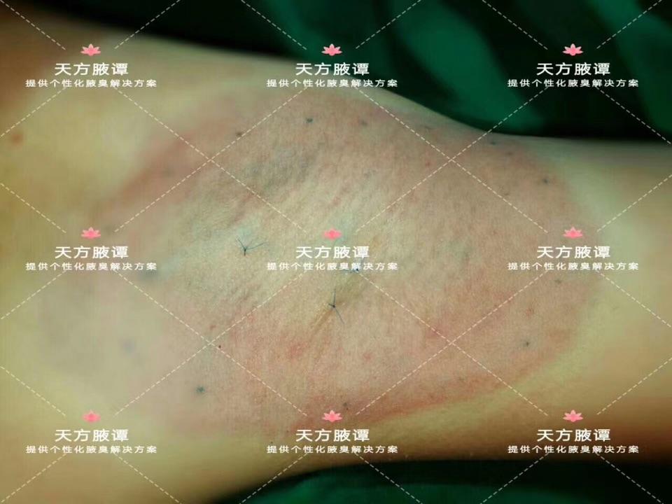 腋臭術後加壓包紮的重要性一千零一腋之903