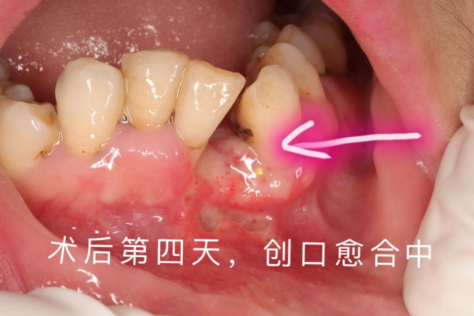 20复诊病检结果是良性的(不是癌症)牙龈瘤来源于牙周膜及颌骨牙槽突的