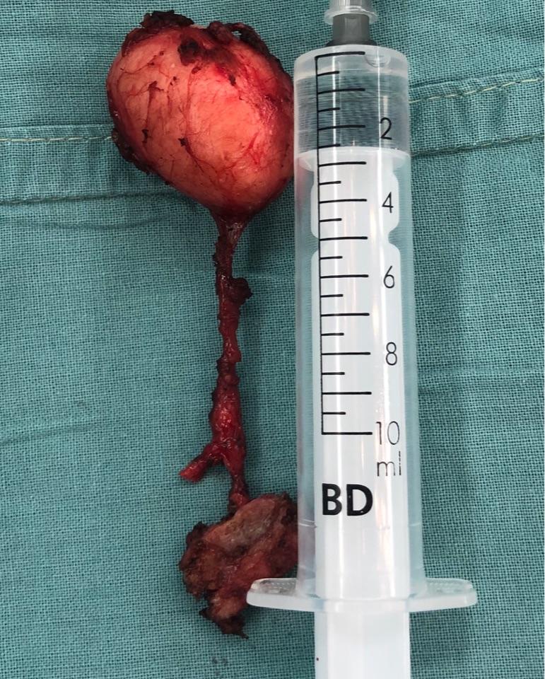 甲状舌管囊肿的诊断与治疗 - 微医(挂号网)