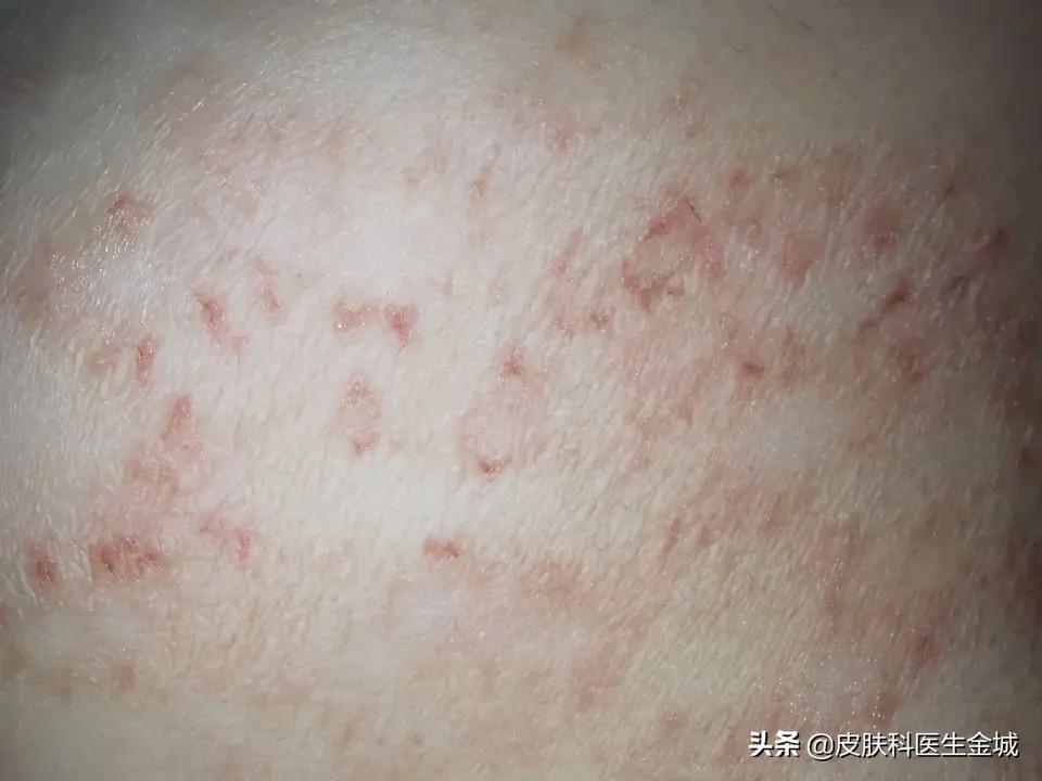 冬季湿疹病人增多为什么呢