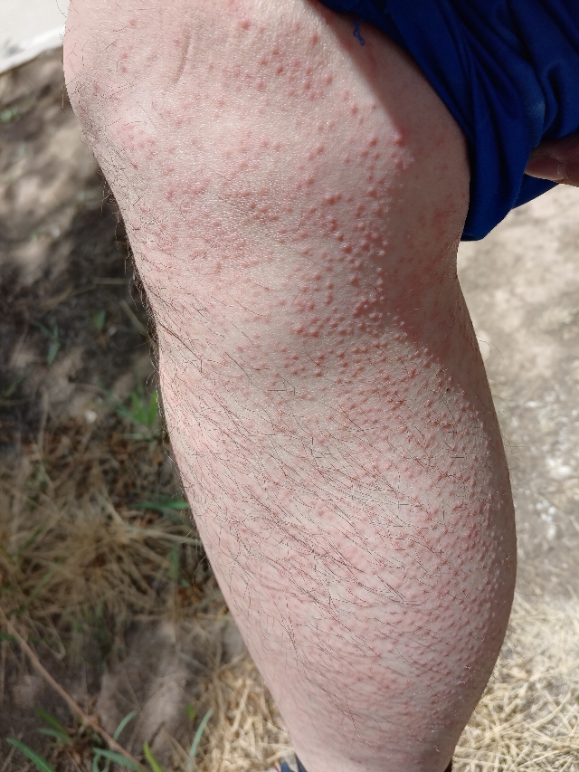 腿上起满红色小疙瘩