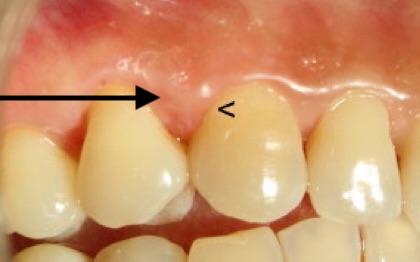 牙龈瘤微创摘除3例