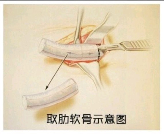 隆鼻取肋软骨对身体有影响吗