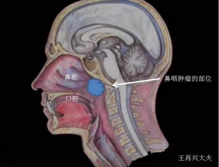 由于鼻咽癌发病的位置比较隐匿,很难早期发现,特别是很多时候鼻咽癌的